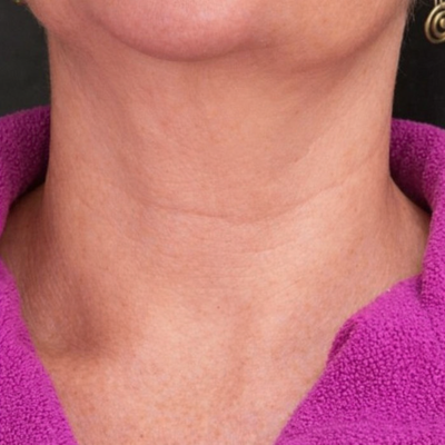 Before - Amanda T.